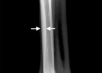 Yarış Atlarında Dorsal Metakarpal Hastalık Nedir?