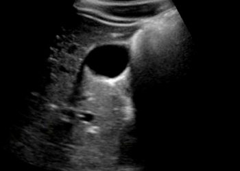 Yan Gölgelenme Artefaktı Nedir?