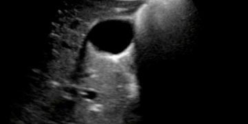 Yan Gölgelenme Artefaktı Nedir?