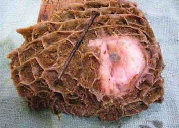 İşkembedeki Yabancı Cisimler