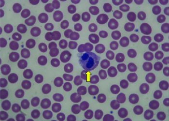 Yalancı Pelger-Huet Anomalisi Nedir?