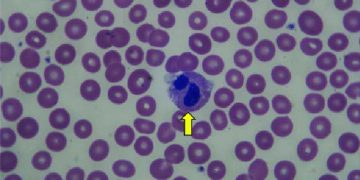 Yalancı Pelger-Huet Anomalisi Nedir?