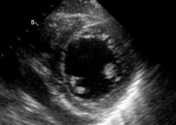 Yalancı Perikarditis Nedir?