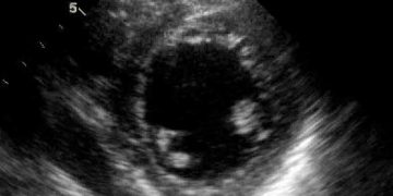 Yalancı Perikarditis Nedir?