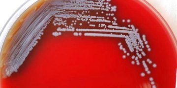 Yalancı Ruam Nedir?