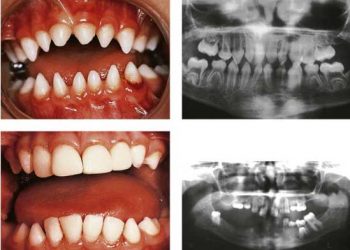 Yalancı Az Dişilik Nedir?