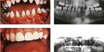 Yalancı Az Dişilik Nedir?