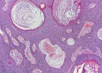 Yalancı Boynuz Kistleri Nedir?