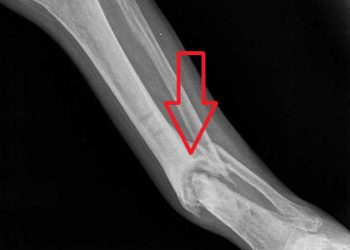 Yalancı Eklem Nedir?