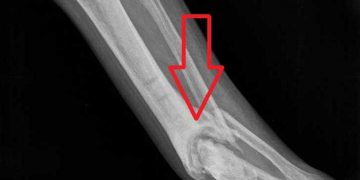 Yalancı Eklem Nedir?