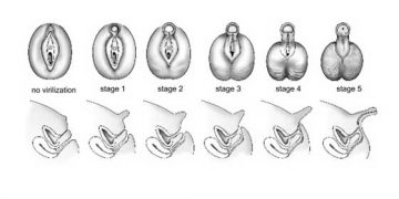 Yalancı Hermafrodizm Nedir?