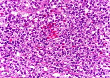 Yalancı Lenfom Nedir?