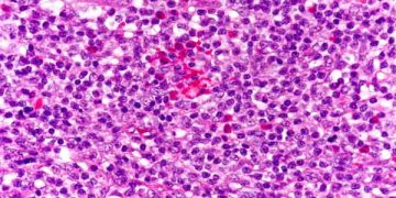 Yalancı Lenfom Nedir?