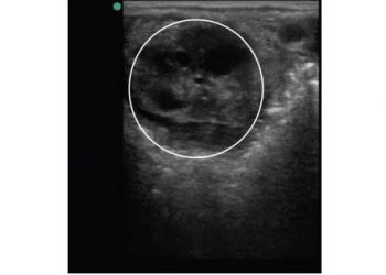 Yalancı Anöstrüs Nedir?