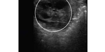 Yalancı Anöstrüs Nedir?