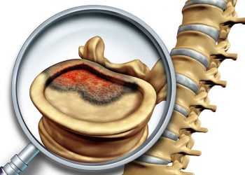 Meningomyelitis Spinalis Acuta (Omurilik ve Omurilik Zarlarının Akut Yangısı)