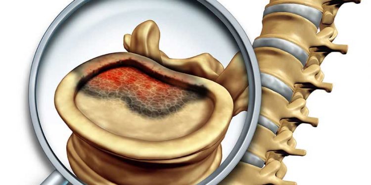 Meningomyelitis Spinalis Acuta (Omurilik ve Omurilik Zarlarının Akut Yangısı)