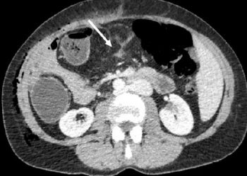 Yağ infiltrasyonu Nedir?