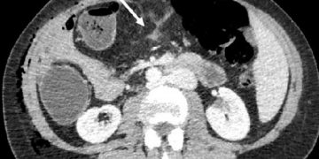 Yağ infiltrasyonu Nedir?