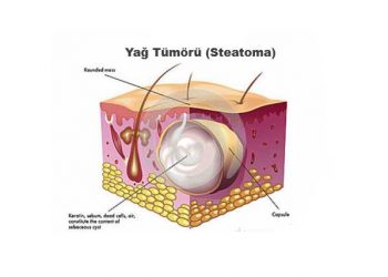 Yağ Tümörü Nedir?