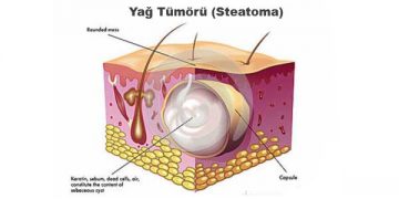 Yağ Tümörü Nedir?