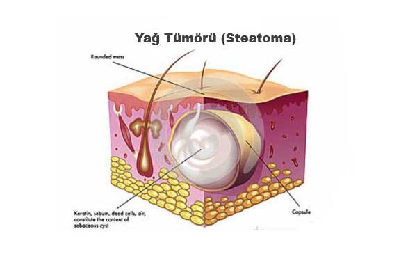 Yağ Tümörü Nedir?