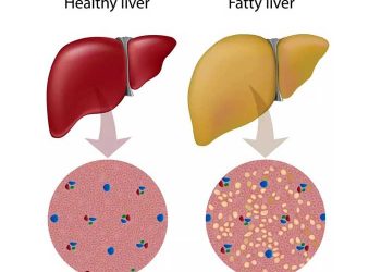 Yağlı Karaciğer Nedir?