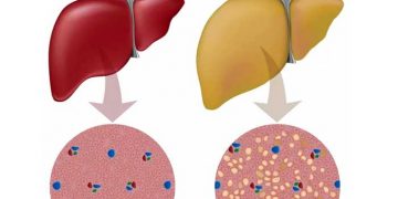 Yağlı Karaciğer Nedir?