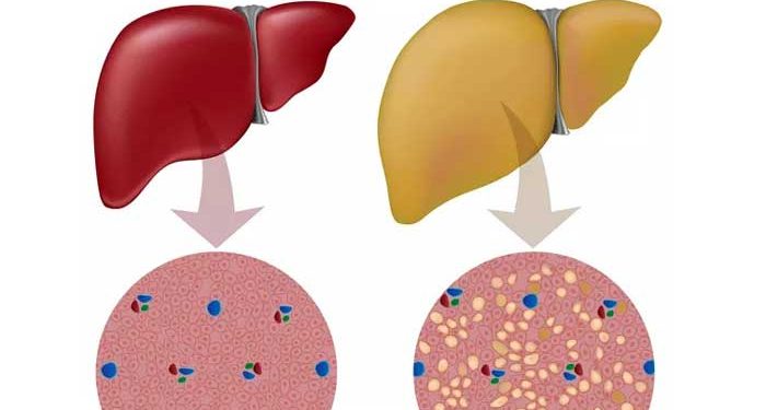 Yağlı Karaciğer Nedir?