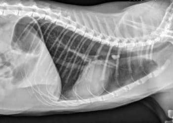 Yabancı Cisim Pnömonisi Nedir?