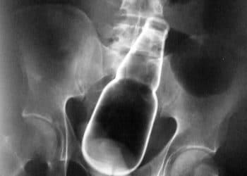 Yabancı Madde Nedir?