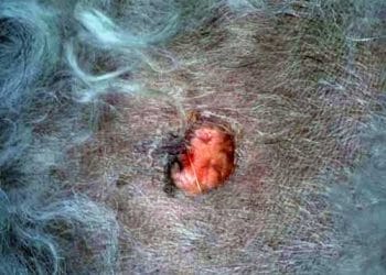 Yağ Bezi Adenomu Nedir?