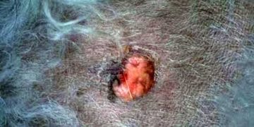 Yağ Bezi Adenomu Nedir?