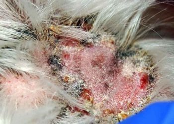 Yağ Bezleri Yangısı Nedir?