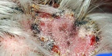 Yağ Bezleri Yangısı Nedir?