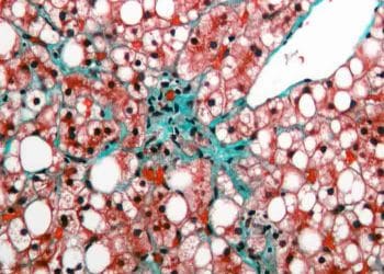 Yağ Dejenerasyonu Nedir?