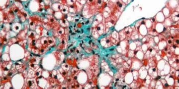 Yağ Dejenerasyonu Nedir?