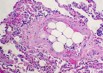 Yağ Embolisi Nedir?