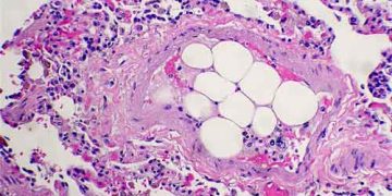 Yağ Embolisi Nedir?