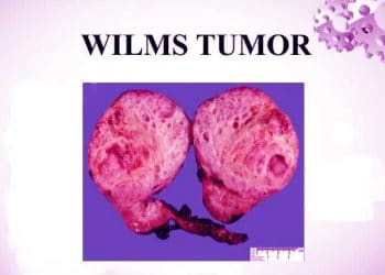 Wilms Tümörü Nedir?