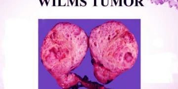 Wilms Tümörü Nedir?