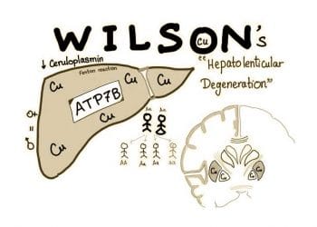 Wilson Hastalığı Nedir?