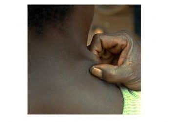 Winterbottom Semptomu Nedir?