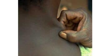 Winterbottom Semptomu Nedir?