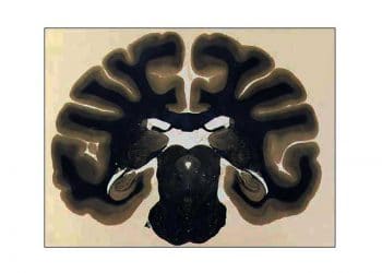 Weil Yöntemi Nedir?