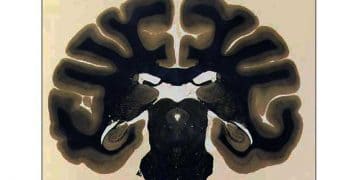 Weil Yöntemi Nedir?