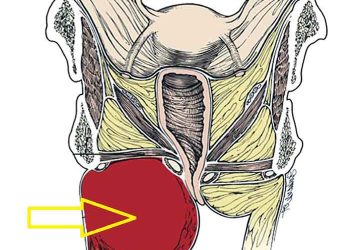 Vulva Vajina Hematomu Nedir?