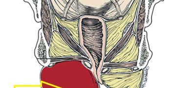 Vulva Vajina Hematomu Nedir?