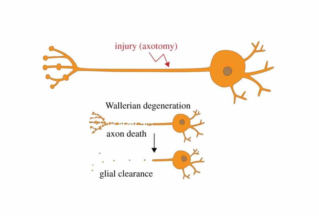 Waller Dejenerasyonu Nedir?