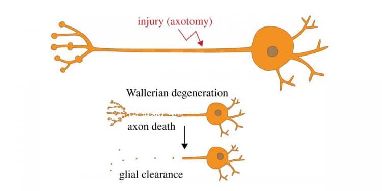 Waller Dejenerasyonu Nedir?